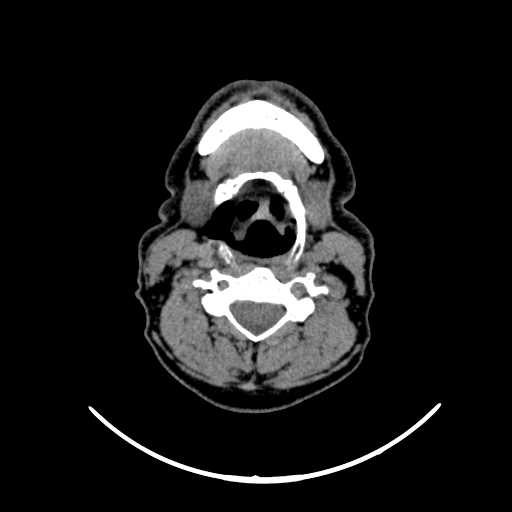 File:Nasopharyngeal carcinoma - infiltrating the clivus (Radiopaedia 62583-70875 Axial non-contrast 44).jpg