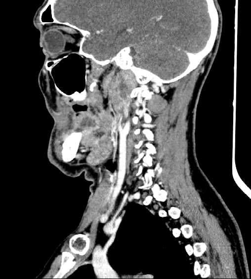 File:Nasopharyngeal carcinoma - infiltrating the clivus (Radiopaedia 62583-70875 C 18).jpg