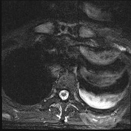 File:Nasopharyngeal carcinoma with skull base invasion (Radiopaedia 59258-66600 Axial T2 fat sat 29).jpg