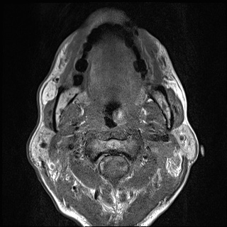Nasopharyngeal carcinoma with skull base invasion (Radiopaedia 59258-66600 B 32).jpg