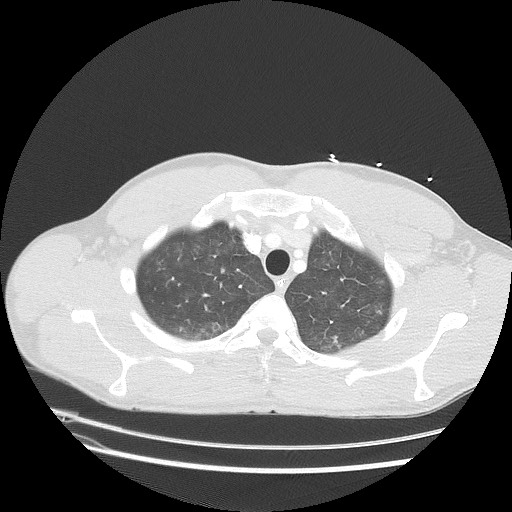 Near-drowning pulmonary edema (Radiopaedia 59457-66814 Axial lung window 10).jpg