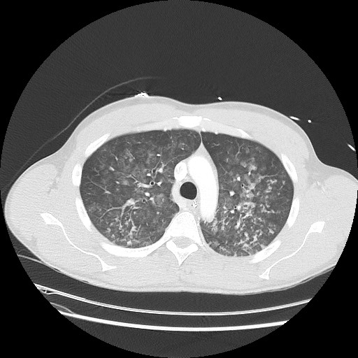 Near-drowning pulmonary edema (Radiopaedia 59457-66814 Axial lung window 18).jpg