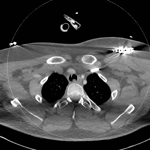 Neck CT angiogram (intraosseous vascular access) (Radiopaedia 55481-61945 B 84).jpg