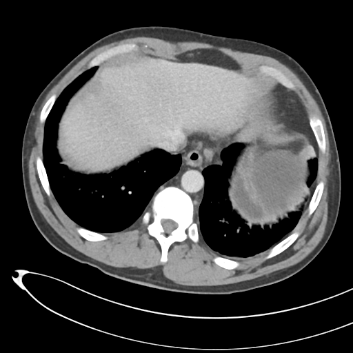 File:Necrotizing pancreatitis with acute necrotic collections (Radiopaedia 38829-41012 B 11).png