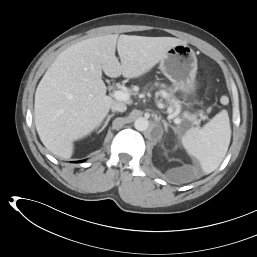 File:Necrotizing pancreatitis with acute necrotic collections (Radiopaedia 38829-41012 B 25).png