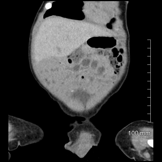 File:Neonatal neuroblastoma (Radiopaedia 56651-63438 Coronal non-contrast 12).jpg