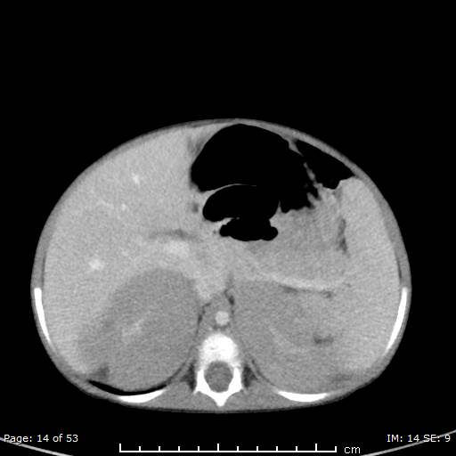 File:Nephroblastomatosis (Radiopaedia 41934-44935 A 14).jpg