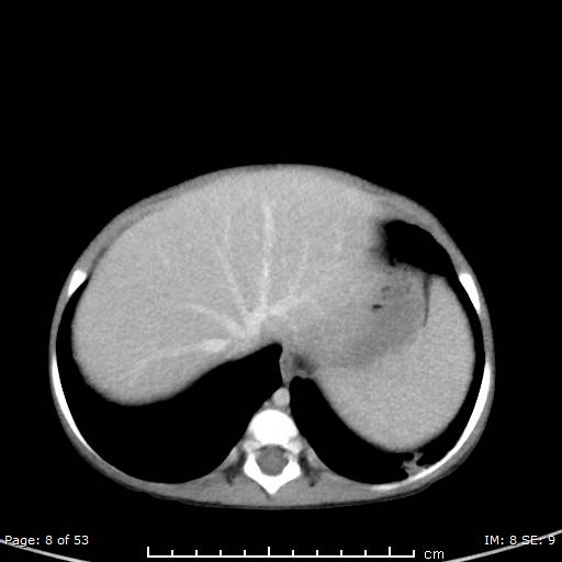 Nephroblastomatosis (Radiopaedia 41934-44935 A 8).jpg
