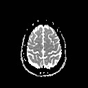 File:Neuro-Behcet's disease (Radiopaedia 21557-21505 Axial ADC 19).jpg