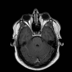 File:Neuro-Behcet's disease (Radiopaedia 21557-21505 Axial T1 C+ 7).jpg