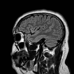 File:Neuro-Behcet's disease (Radiopaedia 21557-21506 Sagittal FLAIR 28).jpg
