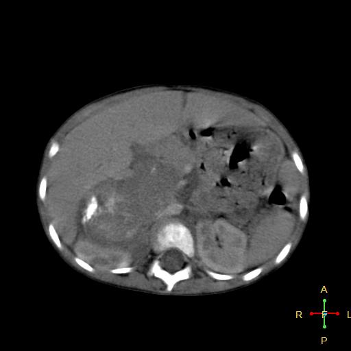 File:Neuroblastoma (Radiopaedia 24751-25016 D 14).jpg