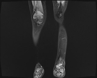 File:Neuroblastoma with bone metastases (Radiopaedia 67080-76414 B 3).jpg