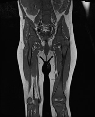 File:Neuroblastoma with bone metastases (Radiopaedia 67080-76414 Coronal T1 13).jpg