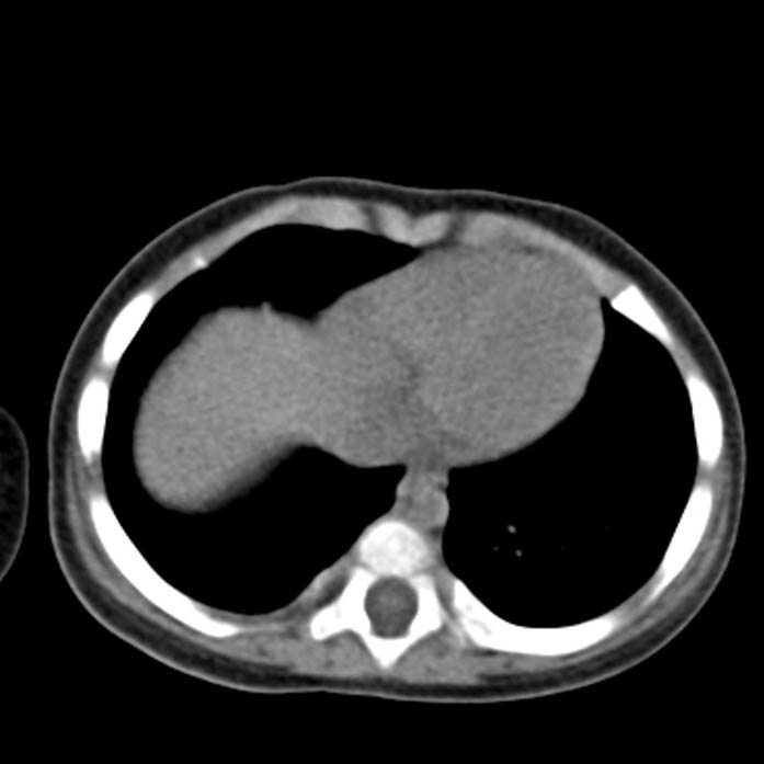 Neuroblastoma with skull metastases (Radiopaedia 30326-30960 Axial non-contrast 1).jpg