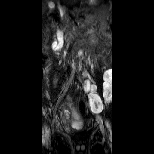 File:Neurofibromatosis type 1- extensive spinal involvement and Christmas tree sign (Radiopaedia 60610-68332 Coronal STIR 3).jpg