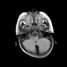 File:Neurofibromatosis type 1 (Radiopaedia 30089-30671 Axial FLAIR 4).jpg