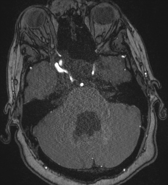 Neurofibromatosis type 1 - head and neck - CNS manifestations (Radiopaedia 49910-55188 Axial MRA 18).png
