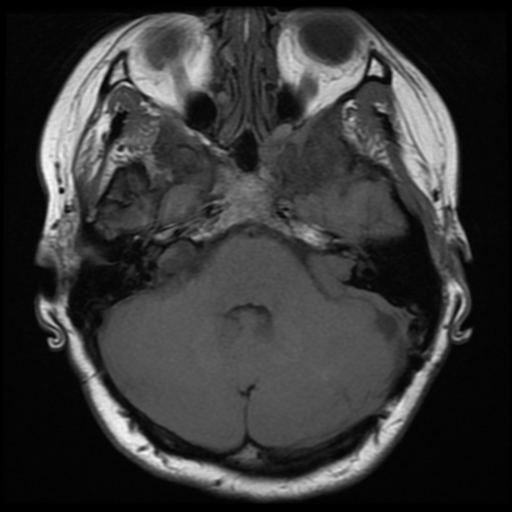 File:Neurofibromatosis type 2 (Radiopaedia 45229-49251 Axial T1 10).png