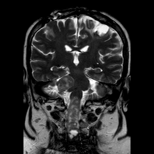 File:Neurofibromatosis type 2 (Radiopaedia 8713-9518 Coronal T2 15).jpg