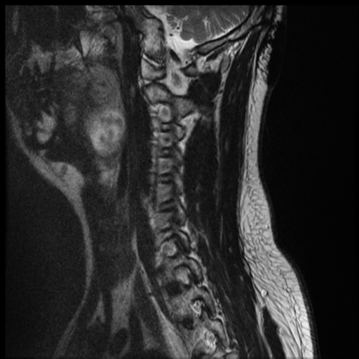 File:Neurofibromatosis type 2 (spinal manifestations) (Radiopaedia 53943-60070 Sagittal T2 3).png