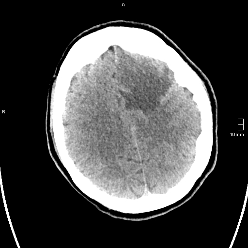 File:Neurotoxoplasmosis - concentric target sign (Radiopaedia 70644-80783 Axial non-contrast 27).jpg