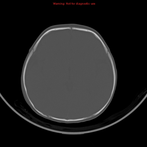 File:Non-accidental injury - bilateral subdural with acute blood (Radiopaedia 10236-10765 Axial bone window 12).jpg