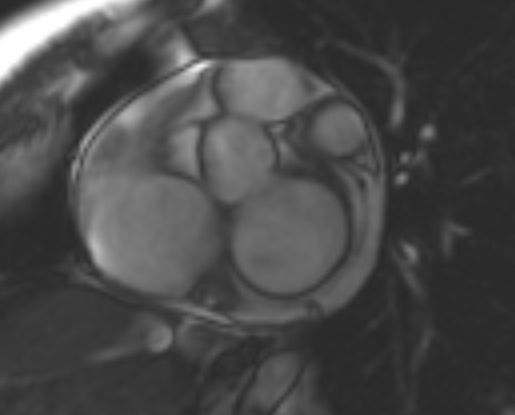 File:Non-compaction of the left ventricle (Radiopaedia 69436-79314 Short axis cine 207).jpg