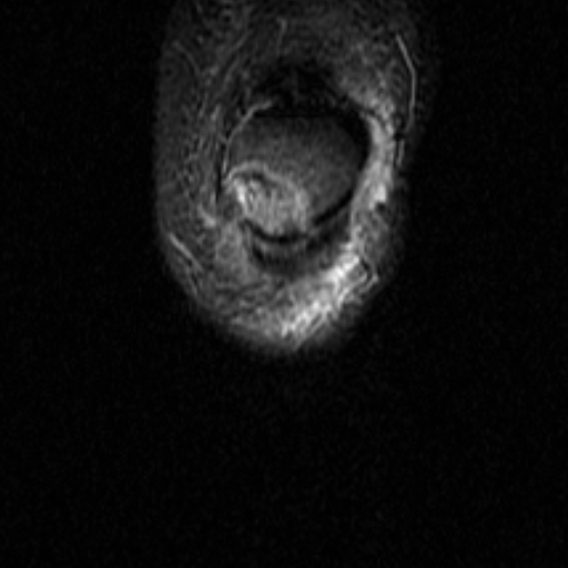 File:Non-displaced patella fracture (Radiopaedia 15932-15582 Coronal STIR 2).jpg