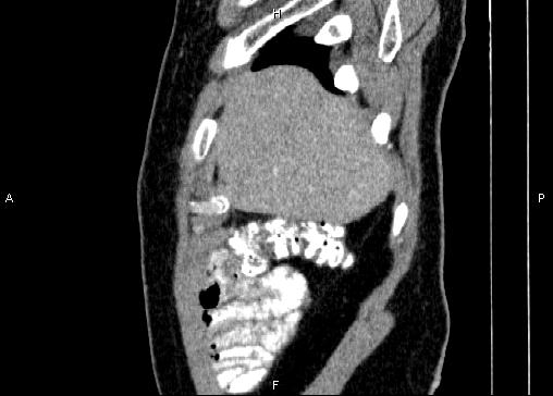 Non-syndromic pancreatic endocrine tumor (Radiopaedia 86958-103178 E 8).jpg