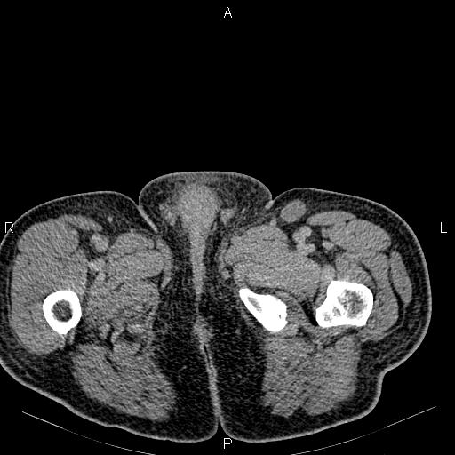 Non Hodgkin lymphoma in a patient with ankylosing spondylitis (Radiopaedia 84323-99621 Axial C+ delayed 97).jpg