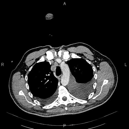 File:Non Hodgkin lymphoma in a patient with ankylosing spondylitis (Radiopaedia 84323-99621 B 11).jpg