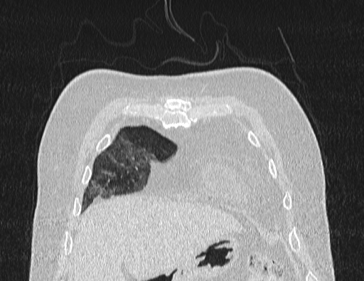 Non specific interstitial pneumonia (NSIP) (Radiopaedia 89725-106798 Coronal lung window 13).jpg