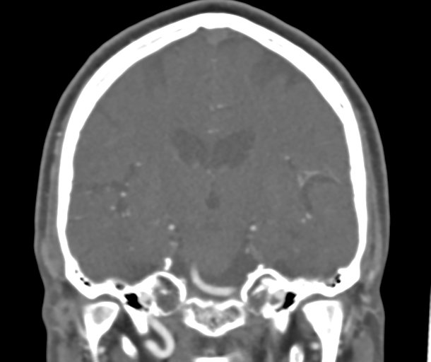 File:Normal CTA head (Radiopaedia 40801-43464 B 53).png