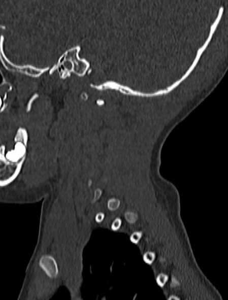 File:Normal CT cervical spine - pediatric (Radiopaedia 52549-58462 Sagittal bone window 12).jpg