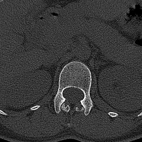 File:Normal CT lumbar spine (Radiopaedia 53981-60118 Axial bone window 10).jpg