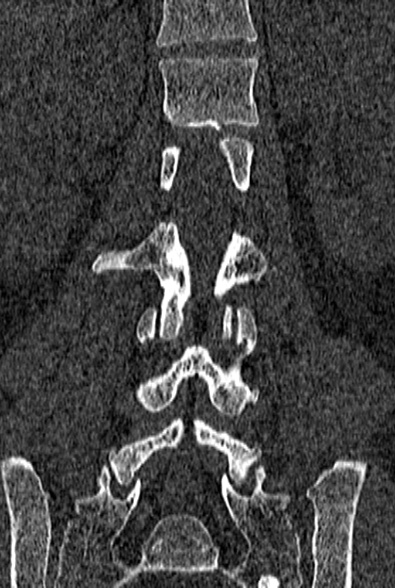 Normal CT lumbar spine (Radiopaedia 53981-60118 Coronal bone window 42).jpg