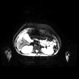 Normal MRI abdomen in pregnancy (Radiopaedia 88001-104541 Axial DWI 39).jpg