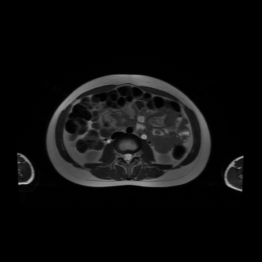 File:Normal MRI abdomen in pregnancy (Radiopaedia 88001-104541 Axial T2 33).jpg