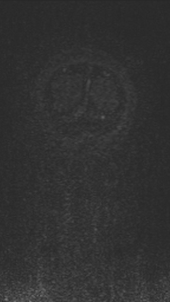 Normal MRI brain with MRV- teenager (Radiopaedia 49425-54553 Coronal MRV 220).jpg