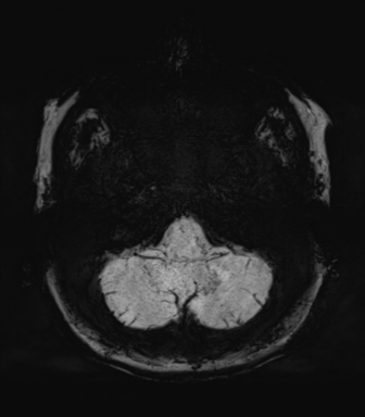 Normal MRI internal auditory canal (Radiopaedia 41613-44525 Axial SWI MIP 11).png