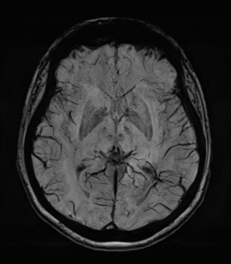 Normal MRI internal auditory canal (Radiopaedia 41613-44525 Axial SWI MIP 39).png