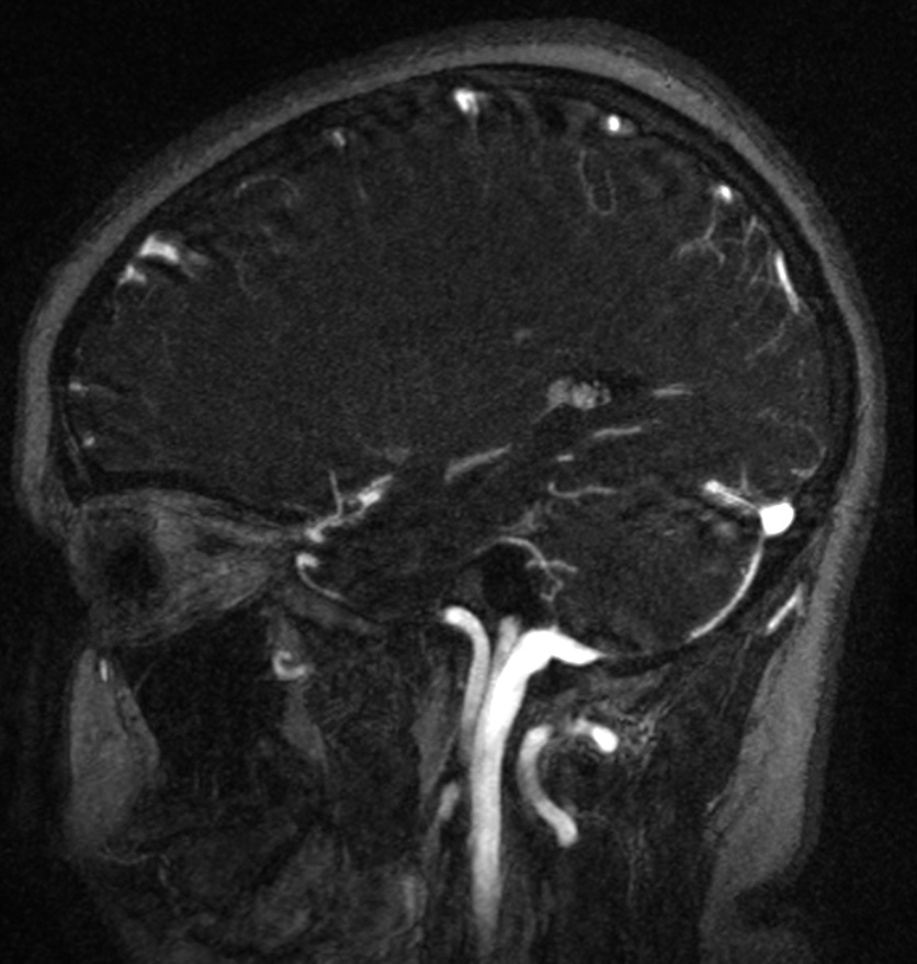 Normal brain MRI and venogram (Radiopaedia 39554-41862 Sagittal MRV 21).jpg