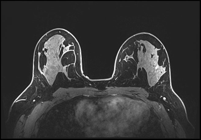 Normal breast MRI - dense breasts (Radiopaedia 80454-93850 C 120).jpg