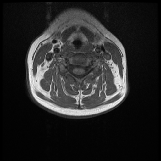 File:Normal cervical and thoracic spine MRI (Radiopaedia 35630-37156 Axial T1 19).png