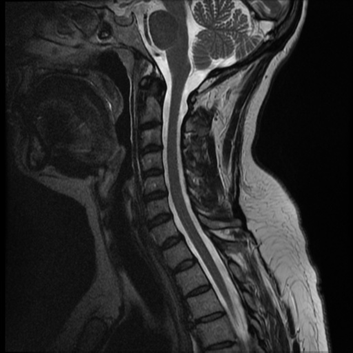 File:Normal cervical and thoracic spine MRI (Radiopaedia 35630-37156 Sagittal T2 7).png