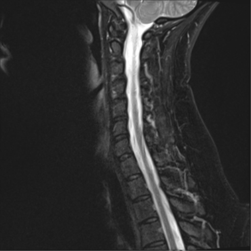 File:Normal cervical spine MRI (including Dixon) (Radiopaedia 42762-45925 Dixon- Water 10).png