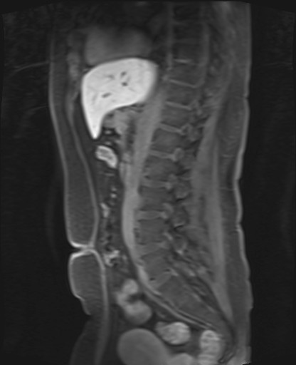 File:Normal hepatobiliary phase liver MRI (Radiopaedia 58968-66230 C 43).jpg