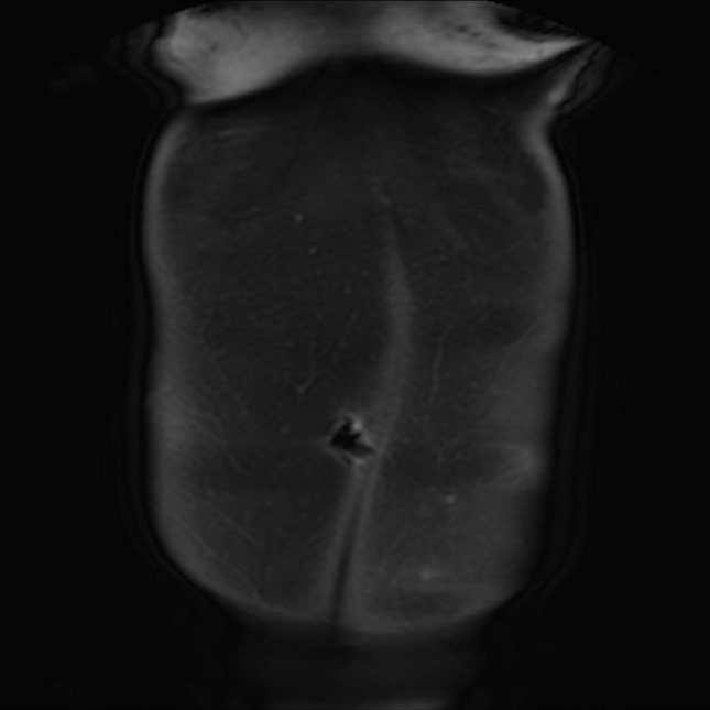 Normal liver MRI with Gadolinium (Radiopaedia 58913-66163 P 4).jpg