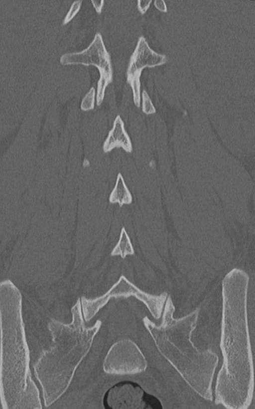 Normal lumbar spine CT (Radiopaedia 46533-50986 Coronal bone window 52).png